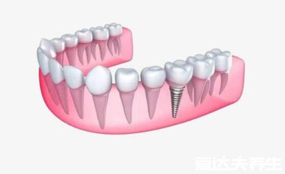 良心醫(yī)生不建議種植牙，有這四種情況的人群千萬注意