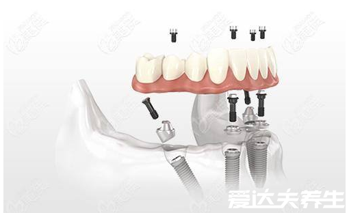 良心醫(yī)生不建議種植牙，周期長費(fèi)用高都不是重點(diǎn)第四點(diǎn)才致命