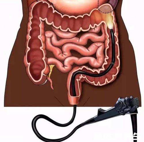過(guò)來(lái)人為什么不建議年輕人做腸鏡，只因胃鏡檢查太疼(可做無(wú)痛)