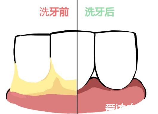 洗牙的好處和壞處，及洗牙后注意事項(xiàng)(忌刺激性食物)