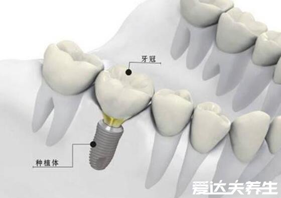 良心醫(yī)生不建議種植牙，因人而異(有全身性疾病等5類人不建議做)