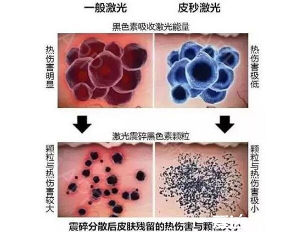 激光祛斑一次多少錢，幾百到上萬元不等和3大因素有關(guān)(價(jià)格表)