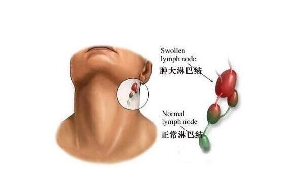 艾滋病自查的10個(gè)方法，一招判斷艾滋病(HIV檢測(cè)試紙最科學(xué))