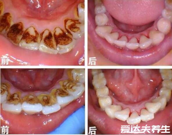 為什么醫(yī)生不推薦洗牙，部分病癥不適合洗牙否則會(huì)加重病情