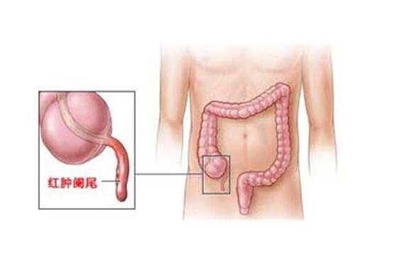 闌尾炎的疼痛位置圖片，位于盲腸與回腸之間人體的右下腹處