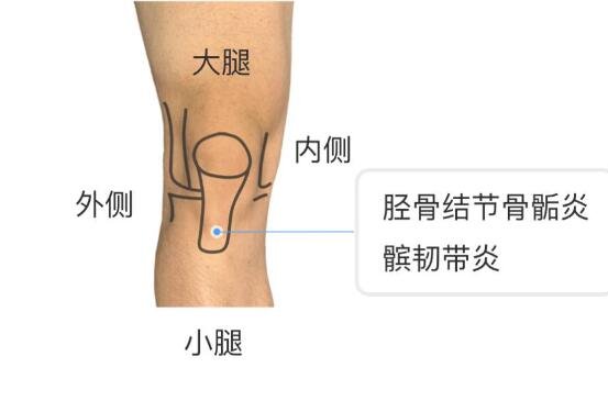 膝蓋各個部位疼痛圖解，膝蓋兩側(cè)疼痛最嚴重須及時就醫(yī)