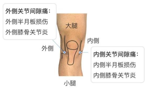 膝蓋各個部位疼痛圖解，膝蓋兩側(cè)疼痛最嚴重須及時就醫(yī)