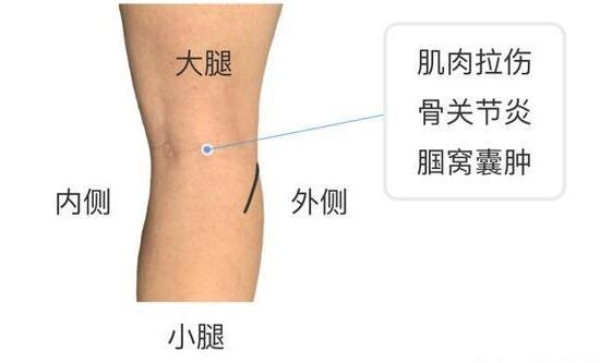 膝蓋各個部位疼痛圖解，膝蓋兩側(cè)疼痛最嚴重須及時就醫(yī)