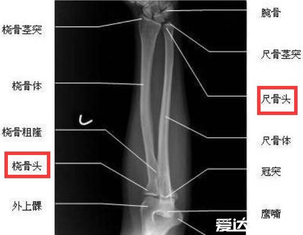 橈骨是哪個(gè)部位圖片，靠近大拇指一側(cè)的長(zhǎng)骨就是橈骨