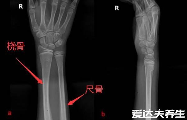 橈骨是哪個(gè)部位圖片，靠近大拇指一側(cè)的長(zhǎng)骨就是橈骨