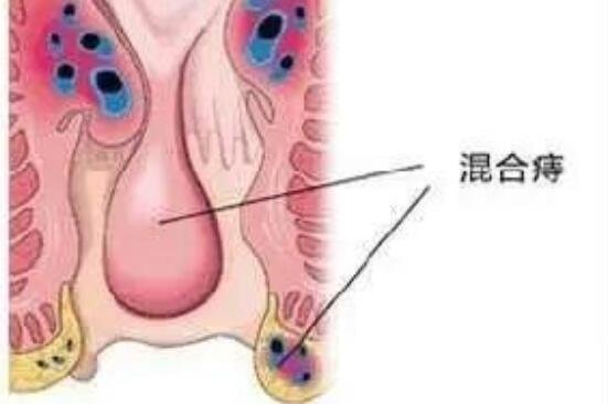 女性痔瘡圖片及注意事項，分外痔/內(nèi)痔/混合痔注意保持肛門清潔