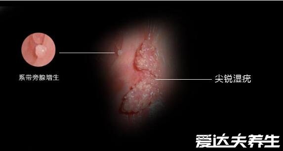 尖濕銳尤典型圖片，尖銳濕疣早期癥狀真假辨別