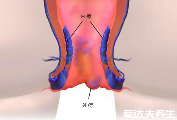 真實(shí)的外痔瘡圖片，4種類型外痔的病因及治療方法