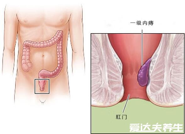 不同程度的內(nèi)痔瘡圖片，一般不嚴(yán)重但嚴(yán)重的必須手術(shù)切除