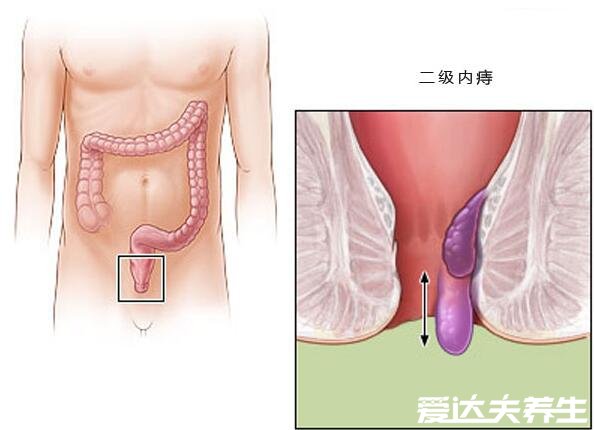 不同程度的內(nèi)痔瘡圖片，一般不嚴(yán)重但嚴(yán)重的必須手術(shù)切除