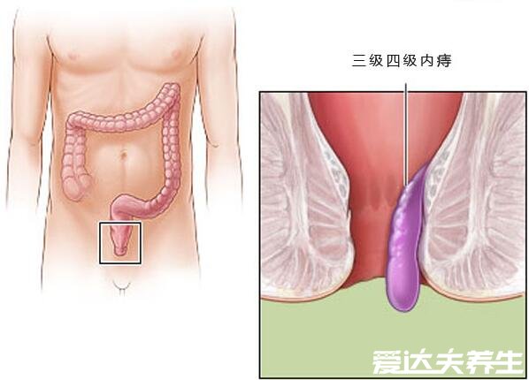 不同程度的內(nèi)痔瘡圖片，一般不嚴(yán)重但嚴(yán)重的必須手術(shù)切除