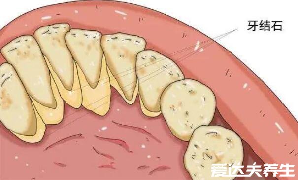 牙結石可以自己摳掉嗎，不要自己扣定期洗牙才是最安全的