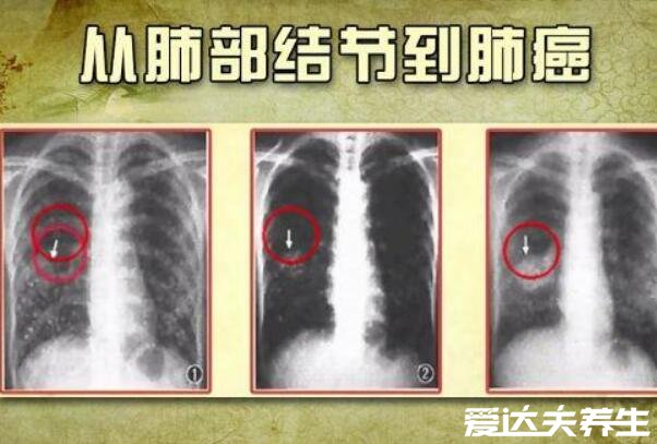 肺結(jié)節(jié)10個人9個人有嗎，不準確但發(fā)病率很高(警惕肺癌)