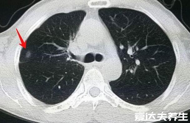 肺結(jié)節(jié)10個人9個人有嗎，不準確但發(fā)病率很高(警惕肺癌)