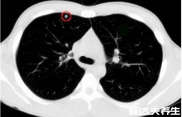 肺結(jié)節(jié)10個人9個人有嗎，不準確但發(fā)病率很高(警惕肺癌)