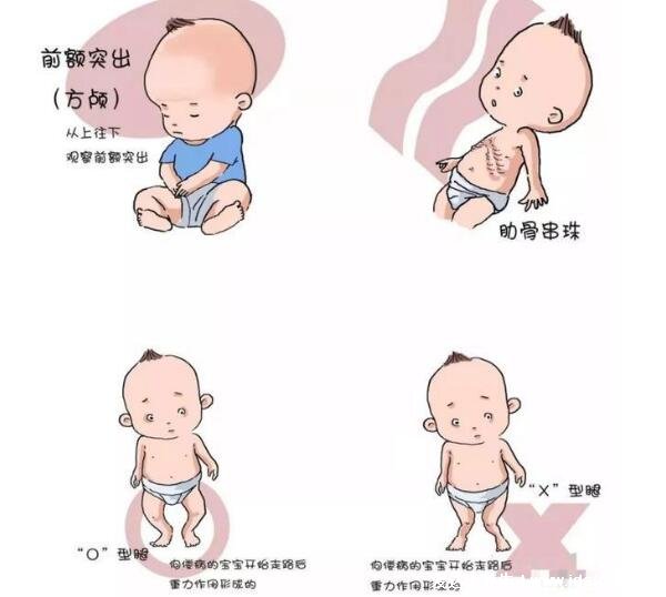 方顱圖片和正常對比，缺鈣導(dǎo)致的畸形佝僂病癥狀