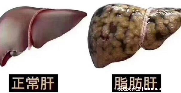 脂肪肝最怕三種食物，經(jīng)常吃還可以遠(yuǎn)離高血脂