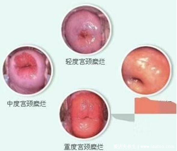 宮頸糜爛一二三度圖片及癥狀，女性一定要重視發(fā)展成宮頸癌就晚了