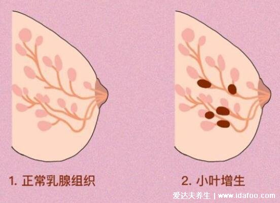 乳腺增生和正常乳腺圖片手感，一個(gè)柔軟一個(gè)異物感強(qiáng)烈區(qū)別很大