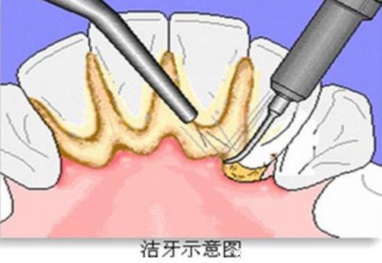 洗牙一次大概多少錢左右，能管多久(一百元可管一年)