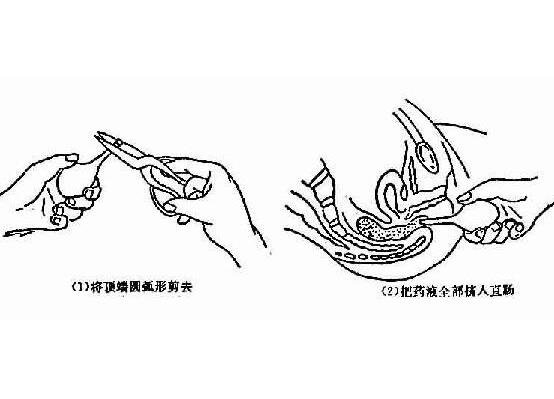 開塞露通便使用方法和姿勢圖片，成人用量一次20ml(切勿多用)