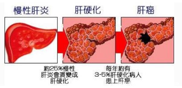 7大肝硬化早期癥狀，警惕蜘蛛痣和肝掌的出現(xiàn)