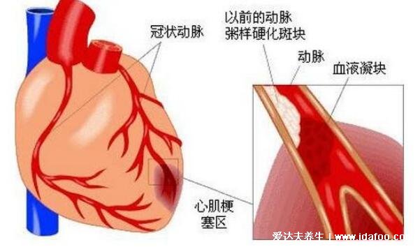 心肌梗塞的前兆和表現(xiàn)，四大癥狀牙疼也可能是心梗前兆