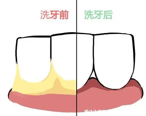 深度洗牙后多久可以刷牙，建議一小時(shí)后再刷牙