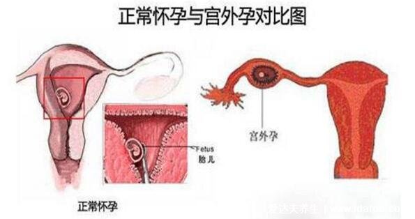 為什么會宮外孕，宮外孕的癥狀有哪些表現(xiàn)(4大原因)