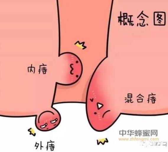 肛門處長了一個肉疙瘩是怎么回事，不一定是痔瘡還有三大原因