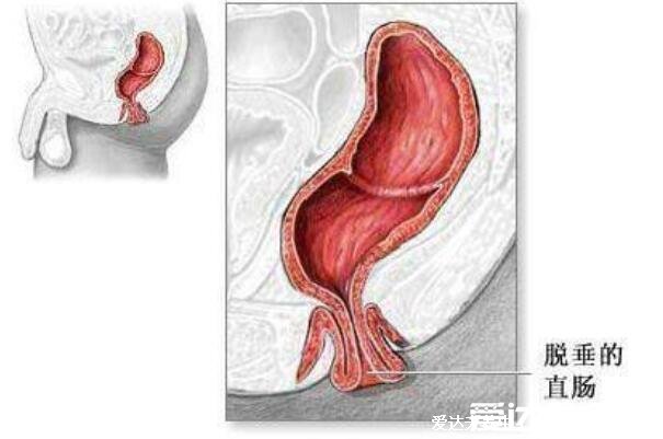 肛門處長了一個肉疙瘩是怎么回事，不一定是痔瘡還有三大原因