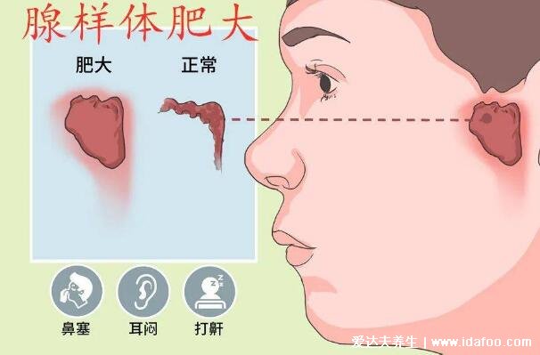 腺樣體面容容貌變丑圖片，怎么判斷小孩腺樣體肥大的癥狀