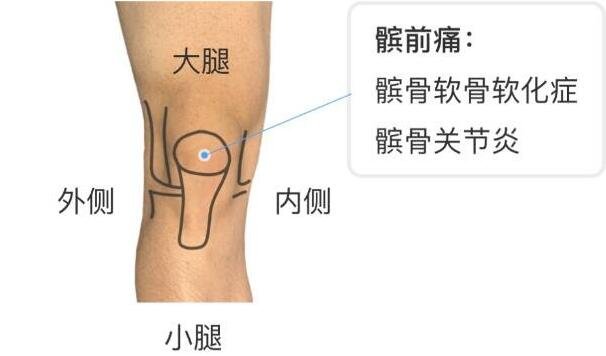 膝蓋疼痛可能有三種病，膝蓋各個部位疼痛圖解(關(guān)節(jié)炎最常見)