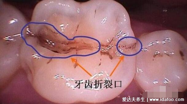 為什么很多人洗牙會(huì)有牙裂，牙齒本身就有的牙隱裂與洗牙無關(guān)
