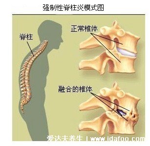 右后背痛病情對照圖，需警惕四種?。ㄅ愿椎蔑L(fēng)濕）