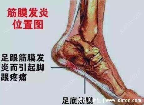 女性足底筋膜炎4個(gè)痛點(diǎn)圖片，跟骨內(nèi)上方最嚴(yán)重(3種止疼方法)