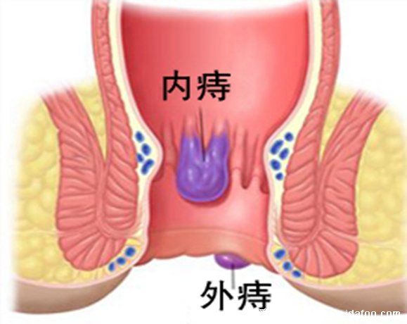 不同程度的內(nèi)痔瘡圖片，一般不嚴(yán)重但嚴(yán)重的必須手術(shù)切除