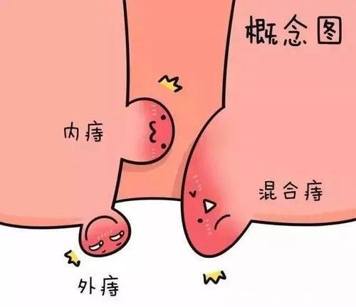 真實(shí)的外痔瘡圖片，4種類型外痔的病因及治療方法