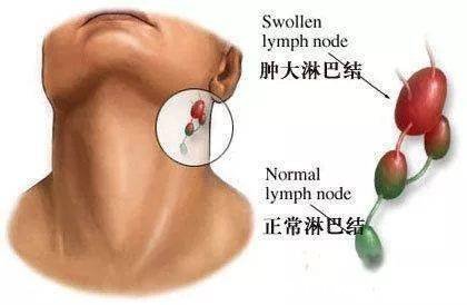 腋窩淋巴結腫大圖片男，淋巴結凸起紅塊可能還疼痛