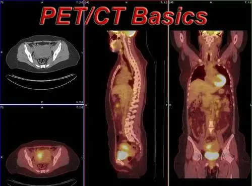 pet-ct是什么檢查，可以用于早期腫瘤檢查