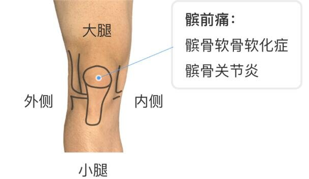 髕骨是哪個(gè)部位圖片，人膝蓋各個(gè)部位疼痛圖解(膝蓋正中心)