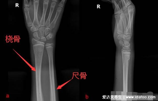 肱骨在哪個(gè)位置圖片，人體連接肩部和上臂的粗壯骨頭(示意圖)