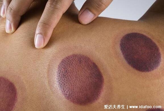 女人拔罐后濕氣重圖片，罐體內(nèi)壁有水汽但不一定有水泡