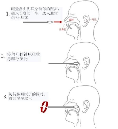 鼻咽拭子采集長(zhǎng)度是多少要進(jìn)去多少厘米，大約4厘米