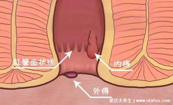 混合痔瘡一期二期三期圖片，三期咳嗽都有痔塊脫垂出來最嚴重